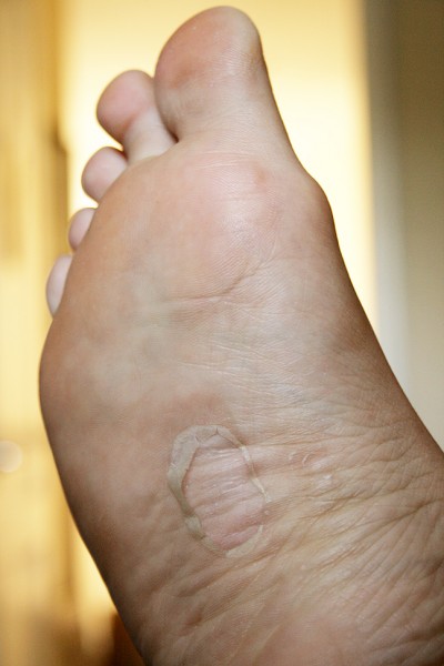 Healing Blister