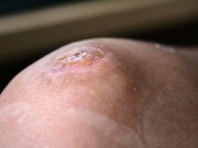 Knee scrape, 17 days later