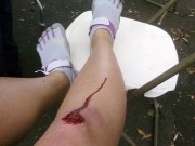 Bloody knee scrape