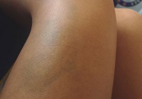 Other than selfies & fond memories from #RayMillerTrailRaces here’s a souvenir that’s finally healing nicely. Nature 2-0 Raciel. #contusion #butdidyoudie [instagram]
