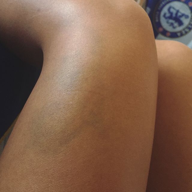 Other than selfies & fond memories from #RayMillerTrailRaces here’s a souvenir that’s finally healing nicely. Nature 2-0 Raciel. #contusion #butdidyoudie [instagram]