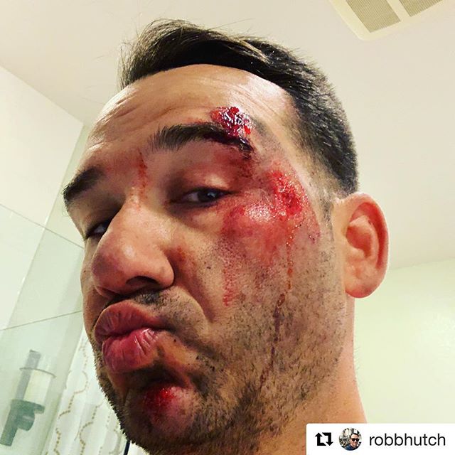 This is my friend @robbhutch and yesterday, he got hurt but thankfully survived a hit-and-Run driver. He’s a small business owner, husband, father of kids who adore him, mountain biker, cyclist, and friend to many in our community. I dread riding on the “open” roads because of drivers who don’t pay attention or worse, have road rage against cyclists. Please be kind, patient, and give riders extra space — the 3 feet room isn’t a suggestion, it’s the law.If you’re really that pissed about bicyclists in “your” lane, then you may have to rethink your life or better yet, try cycling because it’s a great stress reliever (when you aren’t worrying about being hurt by a driver, though...) #Repost @robbhutch with @get_repost・・・Blowing kisses to the douche that #hitandrun me on my #bicycle this morning .. #asshole . [instagram]